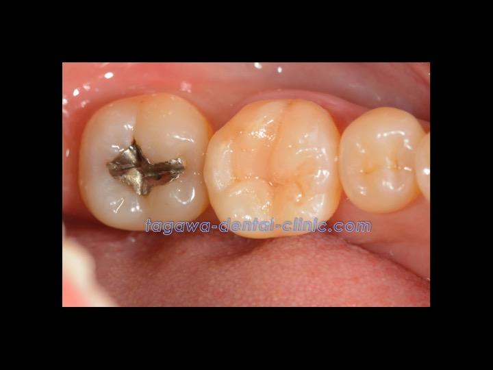 ダイレクトボンディング治療後の歯の状態