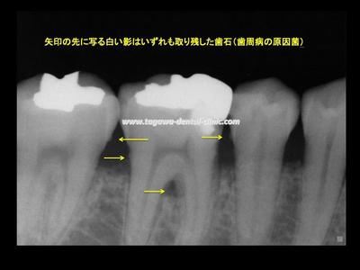歯石の画像