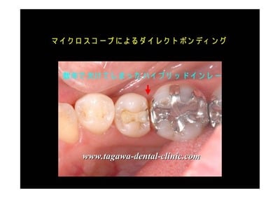 来院時の割れたハイブリッドインレー