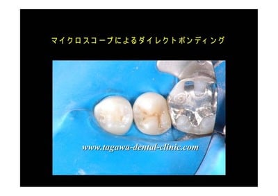 ラバーダム装着時の様子