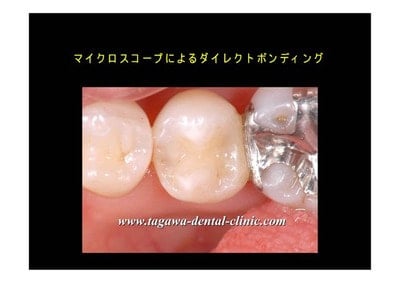 治療後、拡大5倍で見た歯の様子