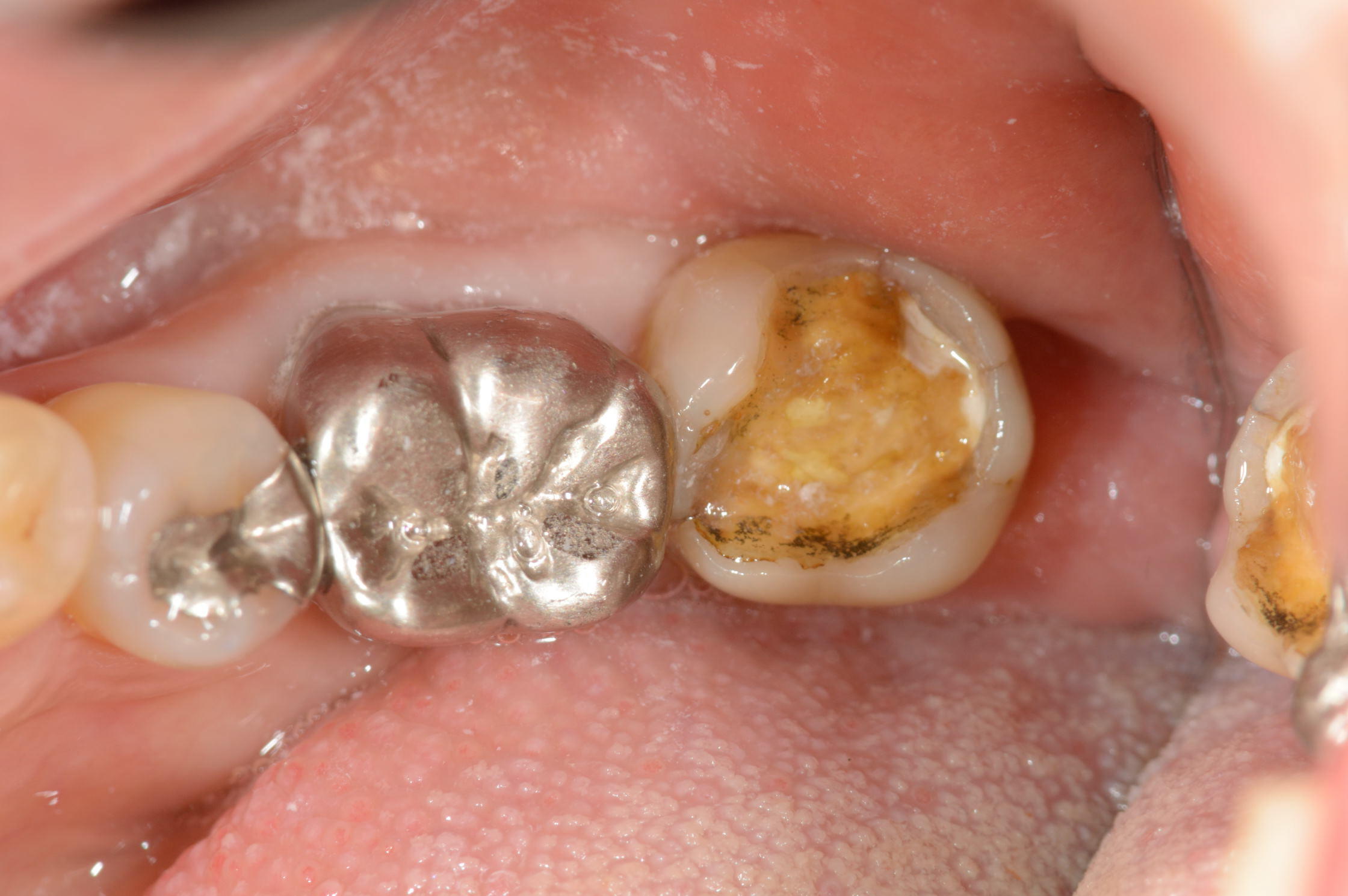 銀 歯 取れ た 応急 処置